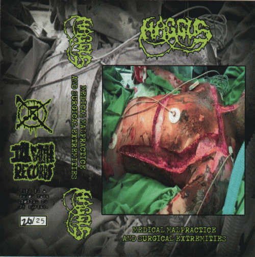 Haggus : Medical Malpractice and Surgical Extremities